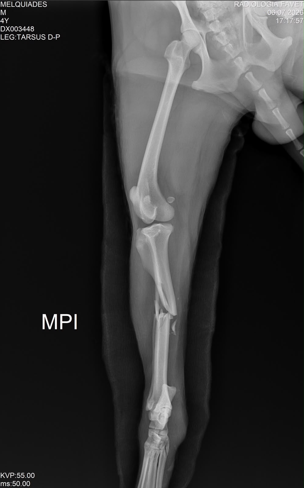 Melquiades Fractura Tibia Peroné