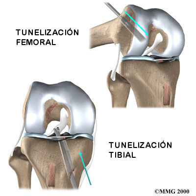 TUNEL