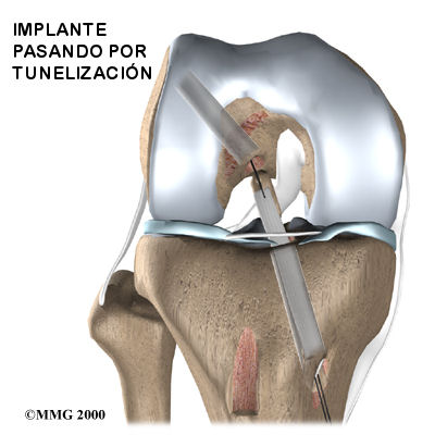 COLOCACIÓN